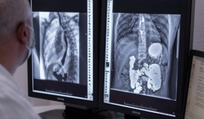 Avances en investigación sobre COVID persistente