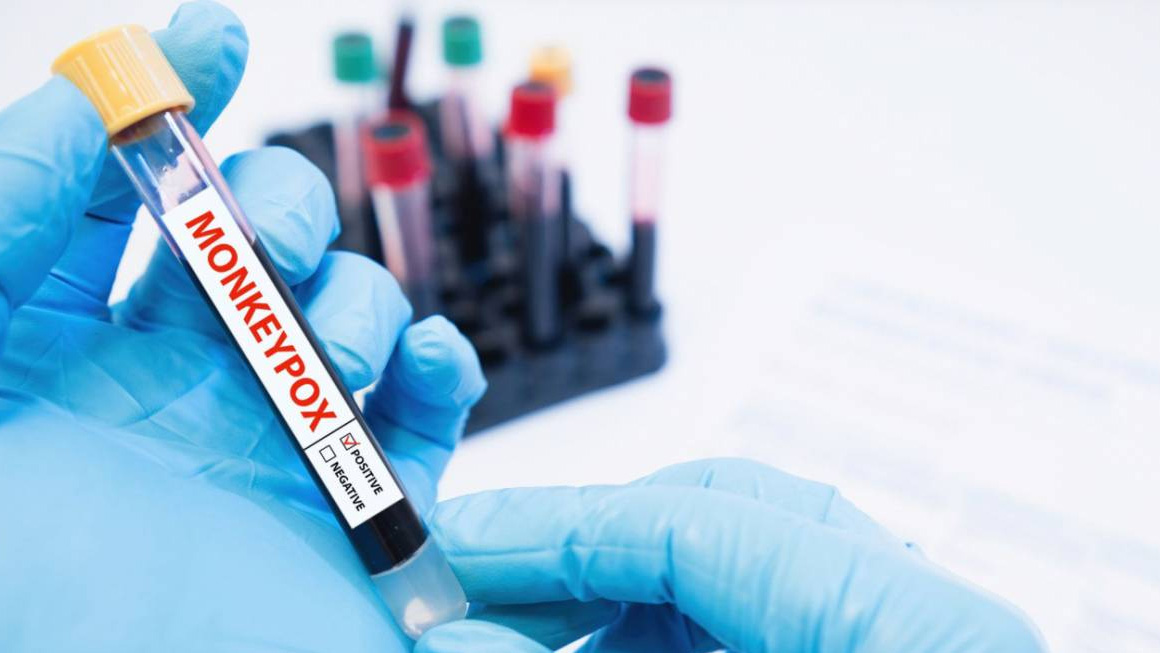 Publicado en The Lancet el primer estudio que analiza las variables clínicas, epidemiológicas y virológicas de la viruela del mono en España