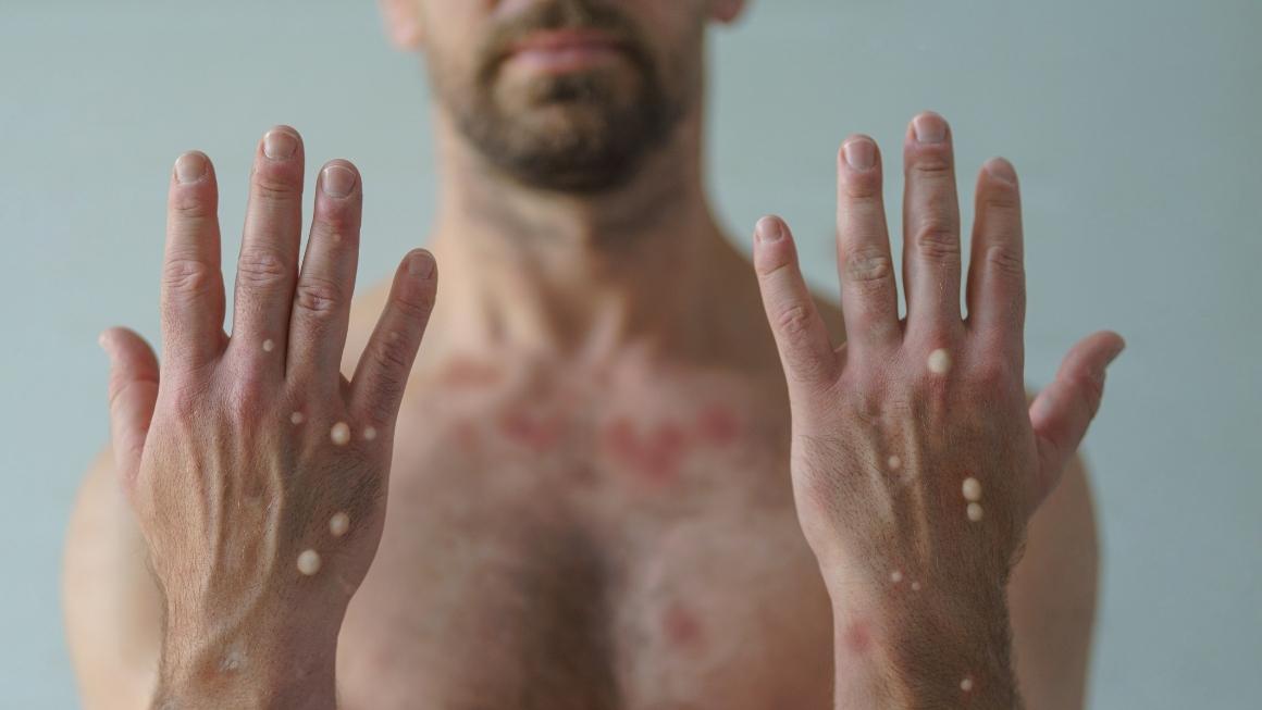 ¿Quieres participar en un estudio sobre la viruela del mono?