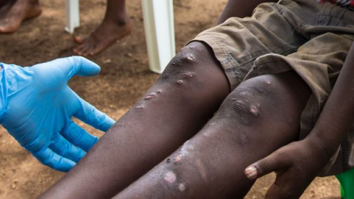 El proyecto Trep-AB busca alternativas terapéuticas para mejorar el tratamiento de la sífilis y el pian